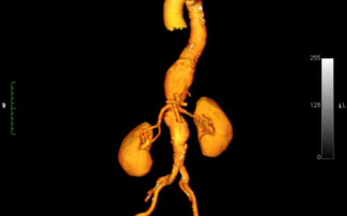 Recontrução tridimensional de angiotomografia